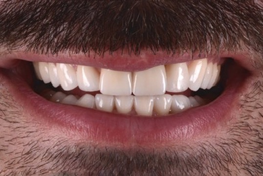 Veneers smile result at Denta-Class