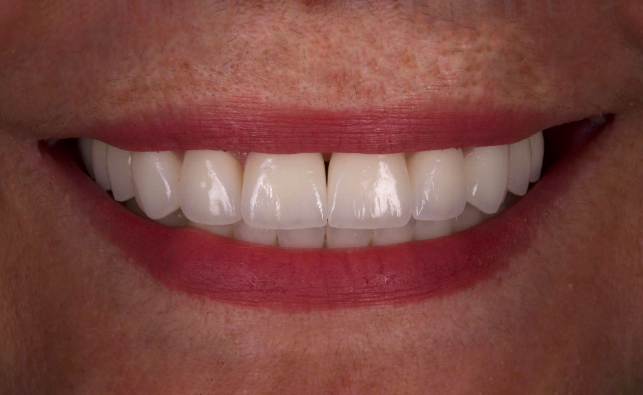 Crown restoration result at Denta-Class