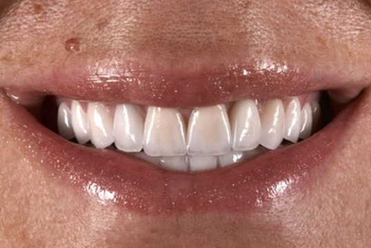 Smile makeover before and after at Denta-Class
