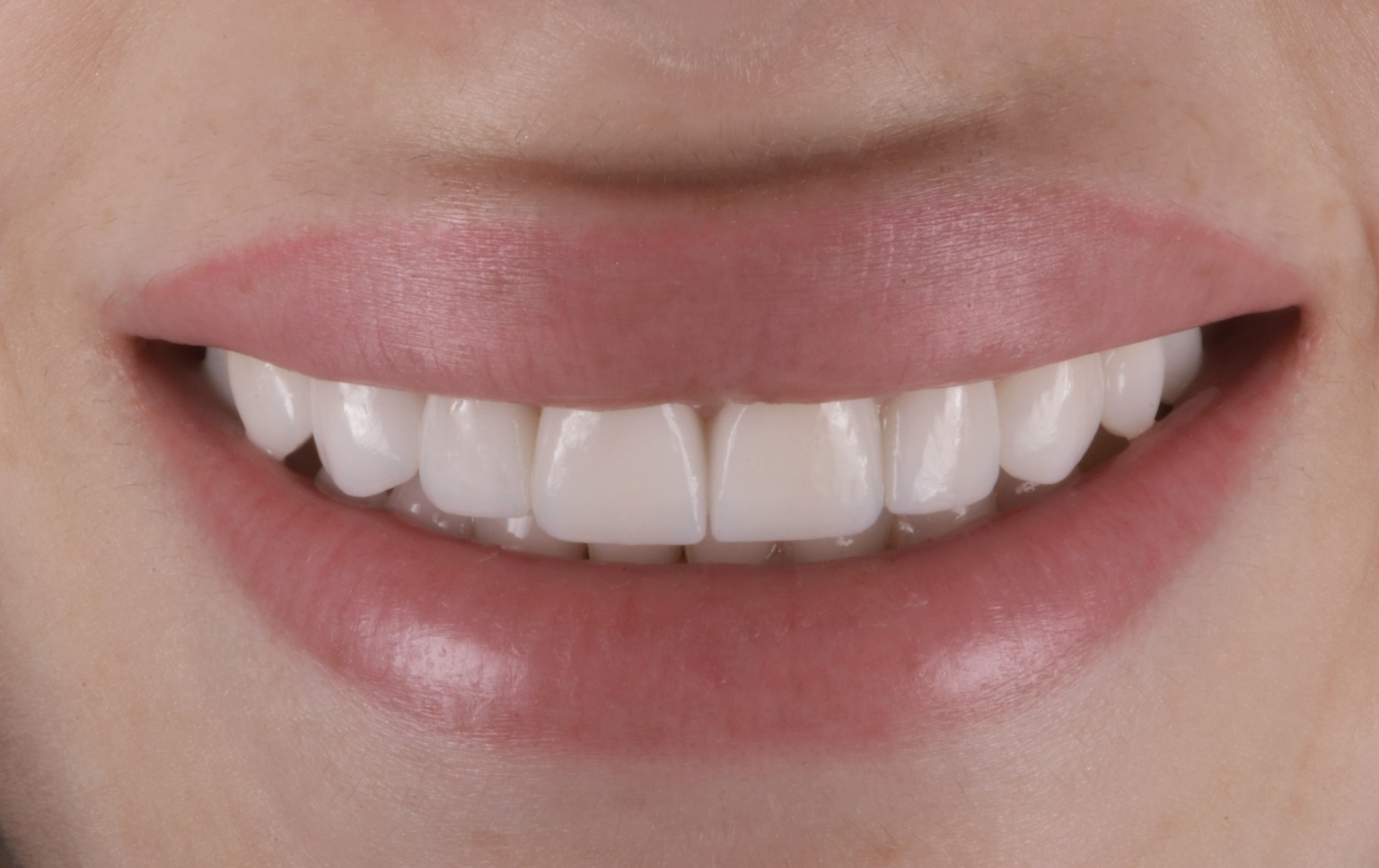 Whitening and cleaning result at Denta-Class