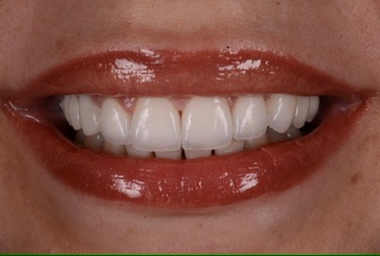 Implant restoration result at Denta-Class