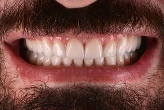 Cosmetic dentistry smile result at Denta-Class